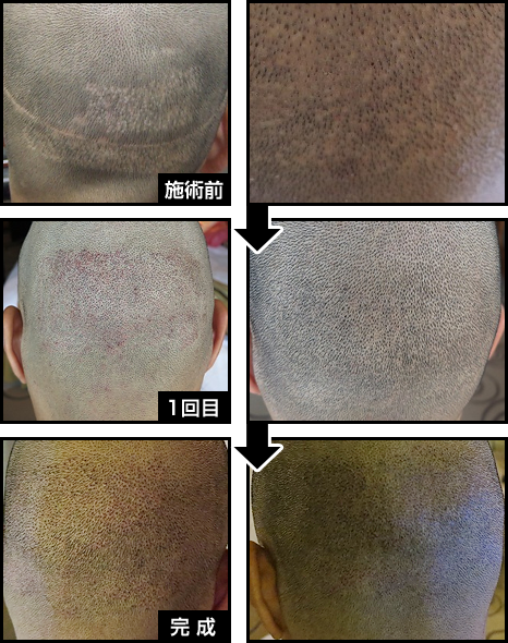 後頭部の植毛の傷のリカバー｜ヘアタトゥー