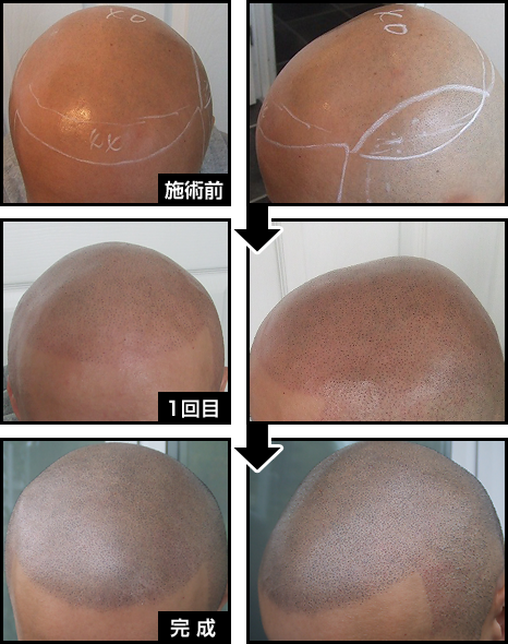 頭部全体のヘアタトゥー施術例