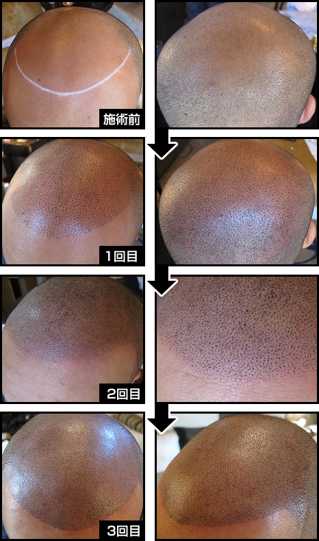 頭部全体の薄毛のヘアタトゥー施術例