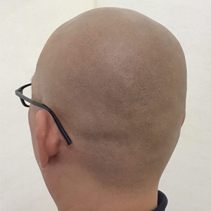 汎発性脱毛症の方のヘアタトゥー体験談