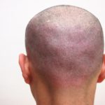 FUE傷は２回でカバーできます。植毛傷に悩む方にはお勧めの方法です。・ヘアタトゥー画像