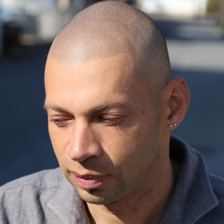 ご本人も「若返った」とお話された通り、ヘアラインで顔が変わります。・ヘアタトゥー画像