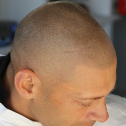 生え際から頭頂部にかけてのドットの濃淡と大きさの違いのグラデーション・ヘアタトゥー画像