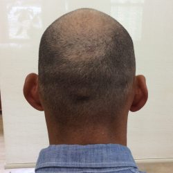 後頭部と襟足も希望されています。・ヘアタトゥー画像