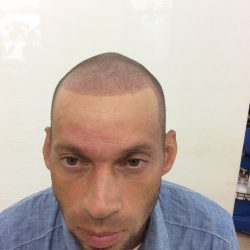 1回目直後。もう雰囲気が変わりました。・ヘアタトゥー画像