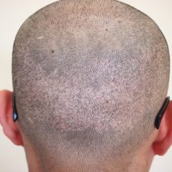 植毛傷で悩まれている方に朗報