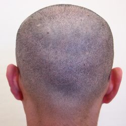 1回目のヘアタトゥー施術で随分分からなくなった傷跡