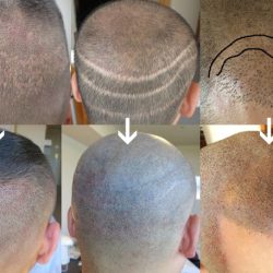 植毛傷に効果的なヘアタトゥーのビフォー・アフター