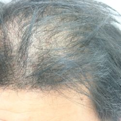 前から見てもすけている感じがします。(before)・ヘアタトゥー画像