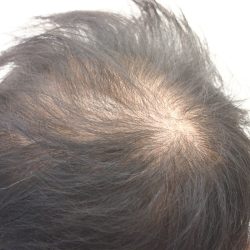 頭頂部の肌感が目立ちます。・ヘアタトゥー画像