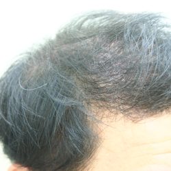 角度的に分かりづらいですが、確実に肌感はカバーされています。・ヘアタトゥー画像