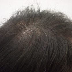 2回目終了時です。横から見ても肌感はカバーされています。・ヘアタトゥー画像