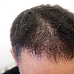 髪が風に吹かれてボサボサになると現れる肌感。・ヘアタトゥー画像