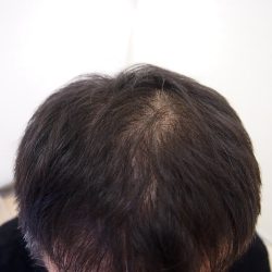 (before) しっかり整えても 頭頂部が気になります。・ヘアタトゥー画像