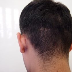 (before)FUT傷が20cmあります。FUE傷は目立ちません。・ヘアタトゥー画像