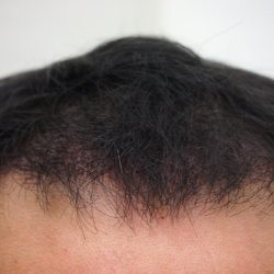 1回目直後です。少しカバーされました。・ヘアタトゥー画像