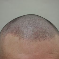 額の幅も狭くなり、若返りました。・ヘアタトゥー画像