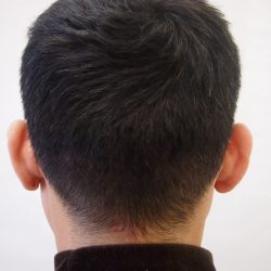 完成。FUT傷も自毛がこの長さなら、ほとんど目立ちません。(傷の幅によります)・ヘアタトゥー画像