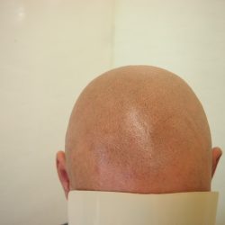 初回施術後です(赤みがなくなった時の写真) 薄っすら色を感じると思います。ドット数は完成時を10とすると3くらいです。・ヘアタトゥー画像