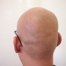 2回終了時点です。(今回は後頭部)感じは出て来ていますが、施術後にカツラを使用するので、蒸れによる定着の不安定さもありそうです。・ヘアタトゥー画像