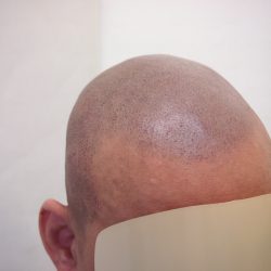 4回目の施術直後の写真です。ドットを打った所が赤くなっているのですが、調整しながらなので、それほど赤みを感じないと思います。・ヘアタトゥー画像