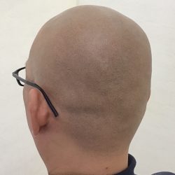 完成時の後頭部です。地黒なので少し存在感のある濃さを望まれました。・ヘアタトゥー画像