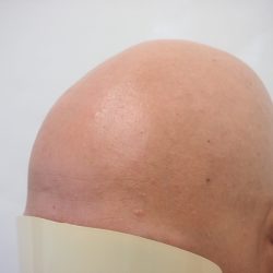 ビフォーは無毛の状態です。フロント位置・仕上がりの濃さ等、不安も多いと思います。・ヘアタトゥー画像