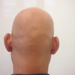 ビフォー 後頭部も無毛状態です。・ヘアタトゥー画像