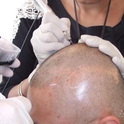 イギリスのHIS hair clinicでヘアータトゥーを受けた②