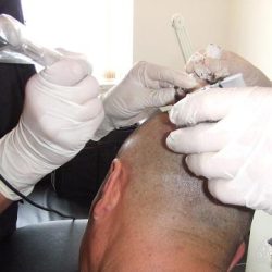 10年前に受けた施術を改めて見てみた(動画付き)