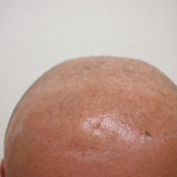 レベル6の薄毛でした。(写真は保湿剤を塗ってあるので、少しテカリがあります)・ヘアタトゥー画像