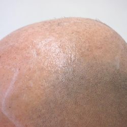 ビフォーです。サイドの髪も少ないので、ここも多めにカバーが必要ですね。・ヘアタトゥー画像