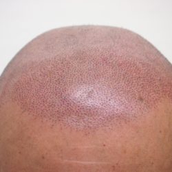 肌感がある所へドットを打つと赤みが目立ちます。回数を重ねると既存のドットの下に赤みがくるので、赤みを感じなくなります。・ヘアタトゥー画像