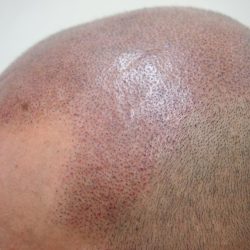 サイドに沢山のドットを感じるかもしれませんが、ドットを打つ時に、しっかり目と浅目の両方を打ってあるので、全部は発色した感じになりません。(下記完成をご覧ください)・ヘアタトゥー画像