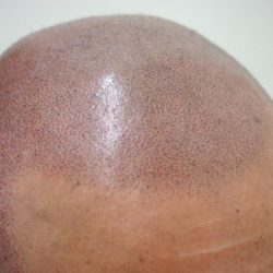 ドット数は9割方打ったので、次回は定着が浅かったドットのムラをカバーします。・ヘアタトゥー画像