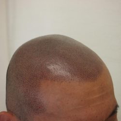 完成です。施術直後で濃く見えますが、赤みが引けば少し濃いくらい。ターンオーバーで1ヶ月後には本来の色味を感じます。・ヘアタトゥー画像