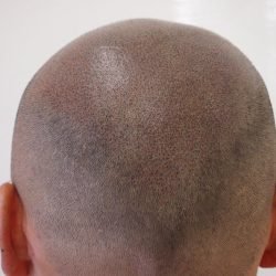 完成です。施術直後なので赤みがありますが、ノックラインも消えました。・ヘアタトゥー画像