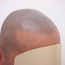 1年後のの写真・ヘアタトゥー画像