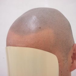 1年後のの写真・ヘアタトゥー画像