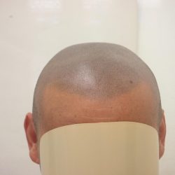 1年経過後のアフター写真です。 日焼けをするので、少し濃い目仕上になっています。・ヘアタトゥー画像