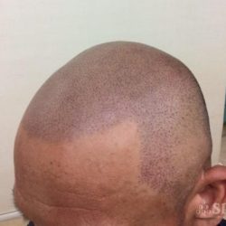 最後のトリートメント直後です。赤みがありますね。・ヘアタトゥー画像