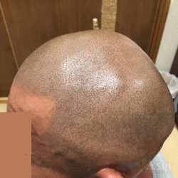 完成直後の赤みが取れた状態です。3ヶ月後が本来の色味になるので、この段階では少し濃い目に見えます。・ヘアタトゥー画像