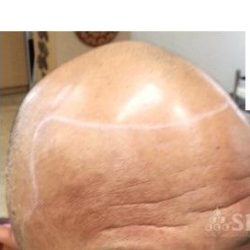 フロント~頭頂部にかけて薄毛が広がっている、レベル5~6の方です。サイドも殆どありません。・ヘアタトゥー画像