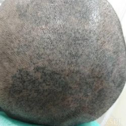 日本国内のヘアタトゥーの現状について/最凶のクリニック