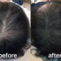 施術経験者対談(ロングヘア女性)